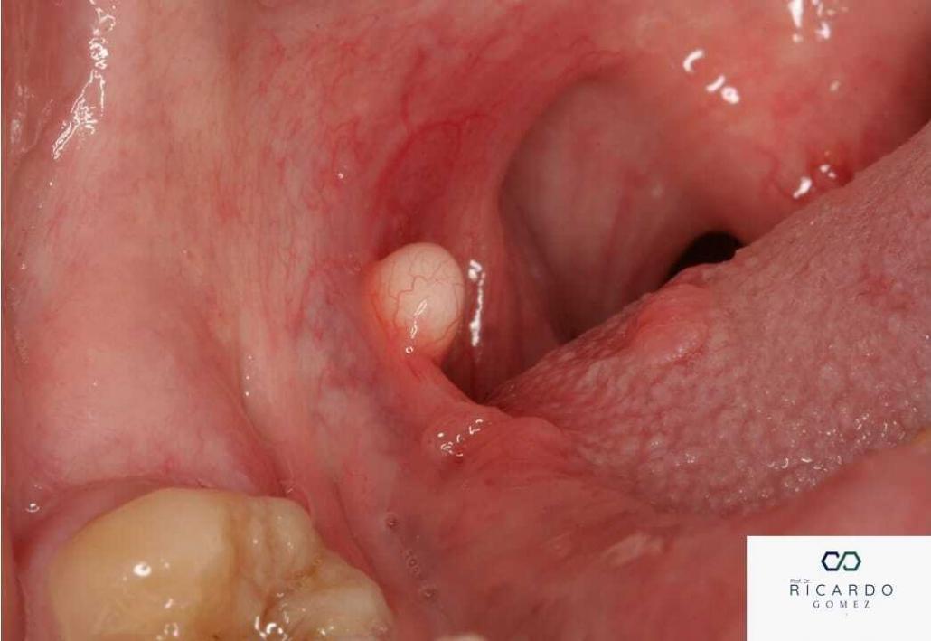 Cisto Linfoepitelial Oral - Patologia Bucal